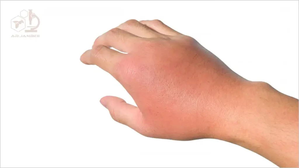 آلرژی به نیش زنبور